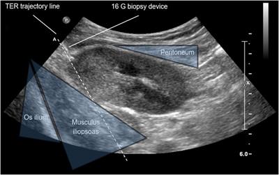 The Tangential Extraperitoneal Retrorenal Approach in Kidney Transplant Biopsy: An Observational Study to Assess Complication and Adequacy Rates